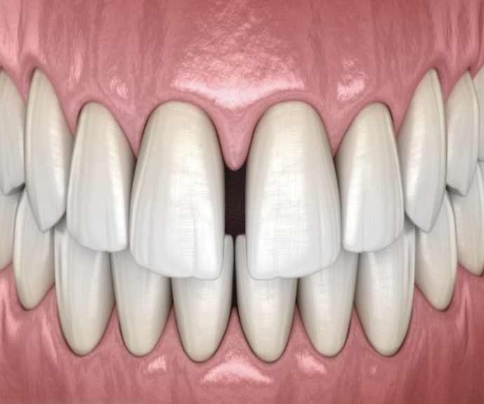“Dientes-separados